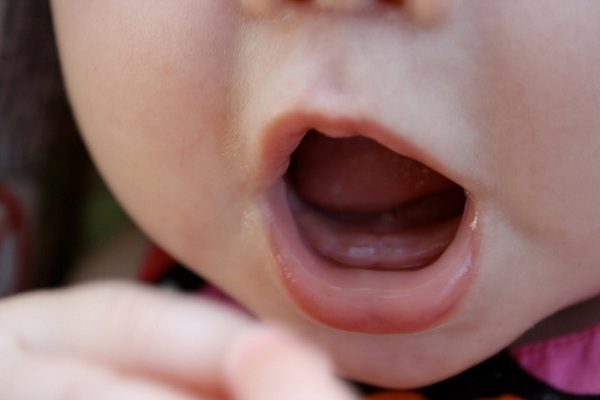 Thiếu canxi khiến răng trẻ mọc chậm, không đều