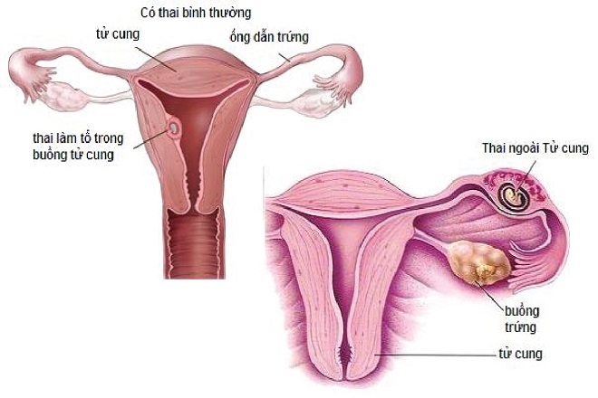 Thai ngoài tử cung là tình trạng thai không làm tổ trong buồng tử cung - Ảnh Internet