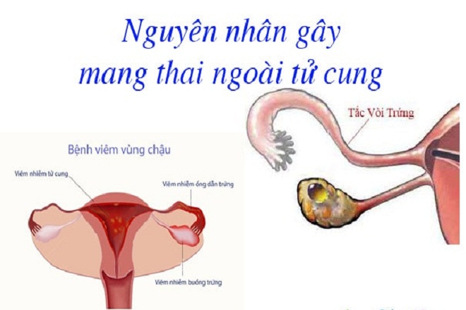 Tắc vòi trứng, viêm vùng chậu là hai nguyên nhân chủ yếu gây ra tình trạng thai ngoài tử cung - Ảnh Interent